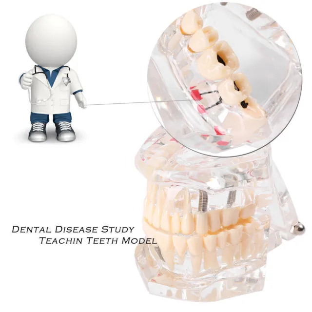 Dental Study Teeth Model Transparent Adult Pathological Disease Tooth New