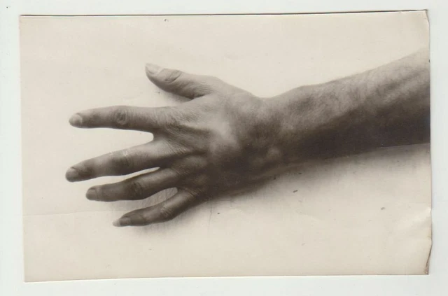 Vintage Medical Oddity Disease Accident Diformity Photo Freak Strange Circus 07