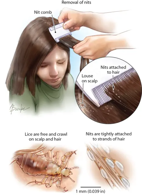 Headlice Double Sided Nit Comb Head Lice Detection Nits Kids Pet Flea Scalp 4