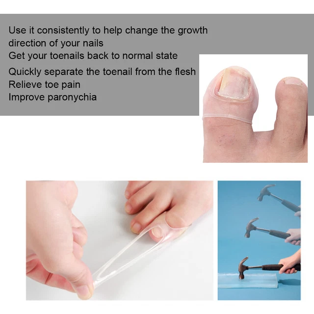 2pcs Silicone Ingrown Toenail Correcting Tool Pain Relief Paronychia Trea UK HEL
