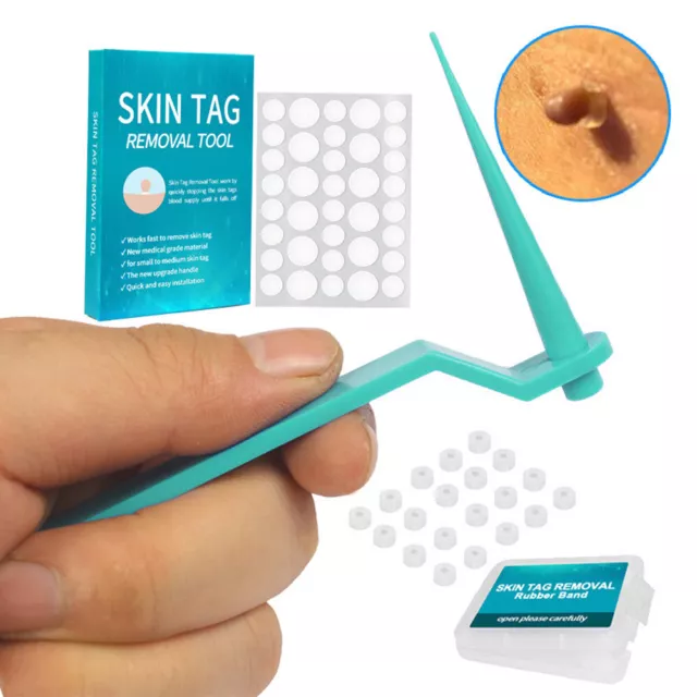 Micro Skin Tag Remover Tool Kit Painless Wart Acne Skin Tags Removal Device Sets