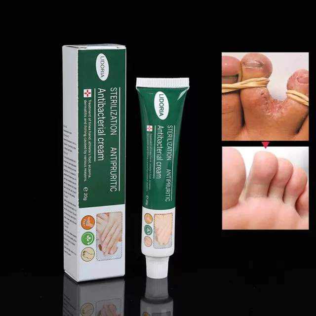 20g Anti Fungal Infections Hand Foot Cream Pain Relief Beriberi  Feet Ointm_tu
