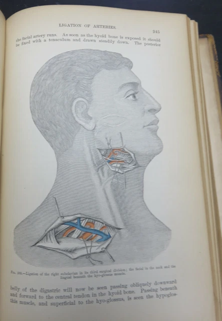 1888 Surgery Text Book John Wyeth Md Civil War Surgen Veteran Illustrations