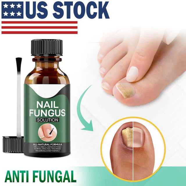 ANTI FUNGAL TREATMENT Extra Strength Toenail Fungus Athletes Foot Fungi