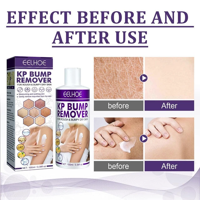 2*KERATOSIS PILARIS REPAIR Cream Exfoliating For Folliculitis Skin