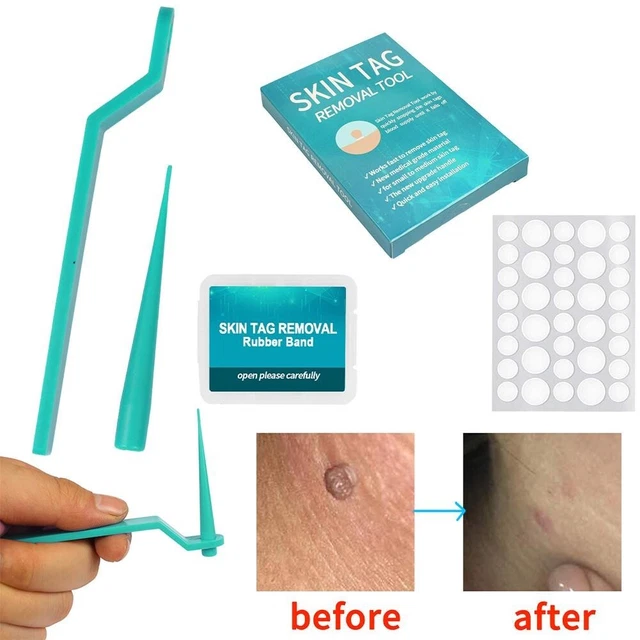 Skin Tag matar la piel apéndice de piel removedor de verrugas topo microbanda