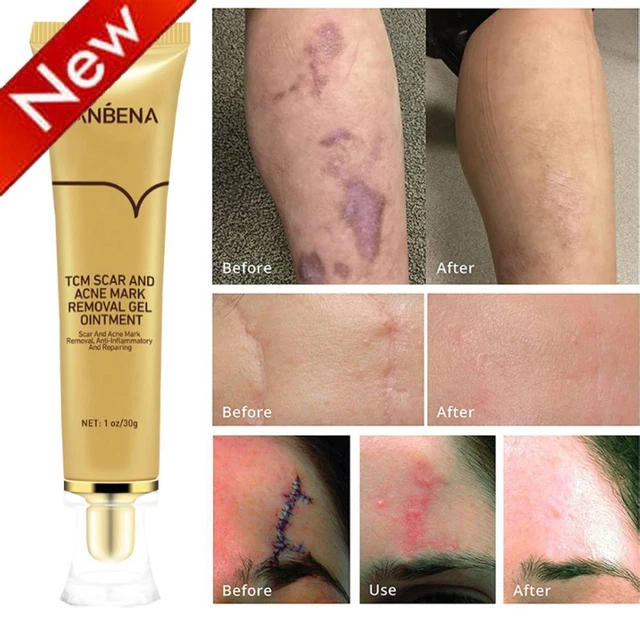 BEST SCAR REMOVAL Cream Skin Care for Scars Reduce Surgery Acne Stretch
