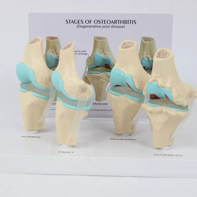 Anatomical Human Degenerative Knee Joint Disease Model Medical Skeleton Anatomy