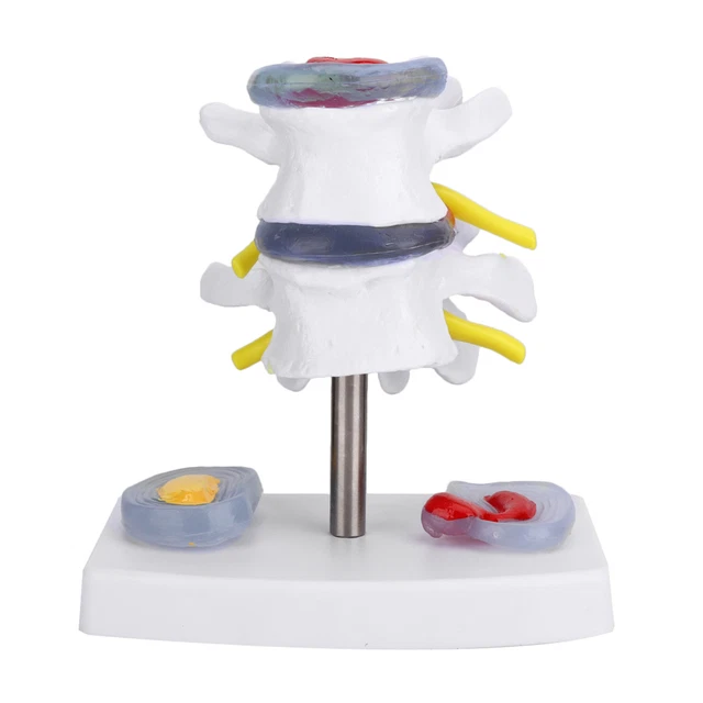 ANATOMICAL LUMBAR DISC Herniation Demonstration Model Human Spine ...