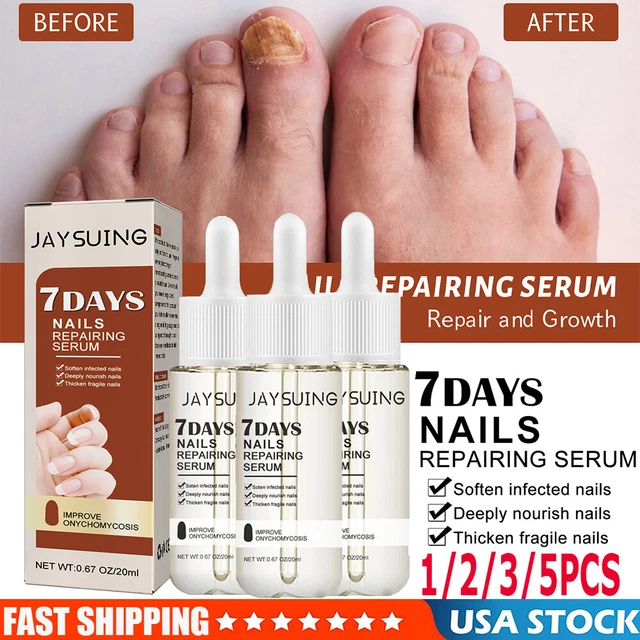 5/3PCS NAIL REPAIR Essence Remove Onychomycosis Serum Fungal Nail