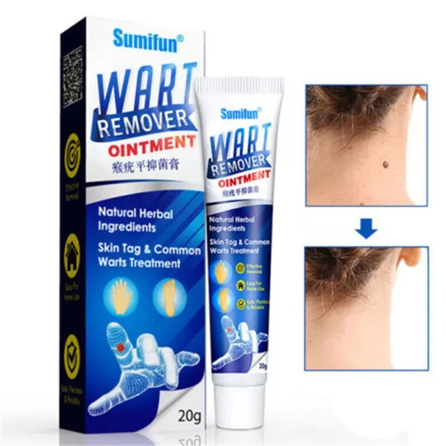 20g Warts Remover Sumifun Treatment Cream Skin Ointment Wart Tag Remover