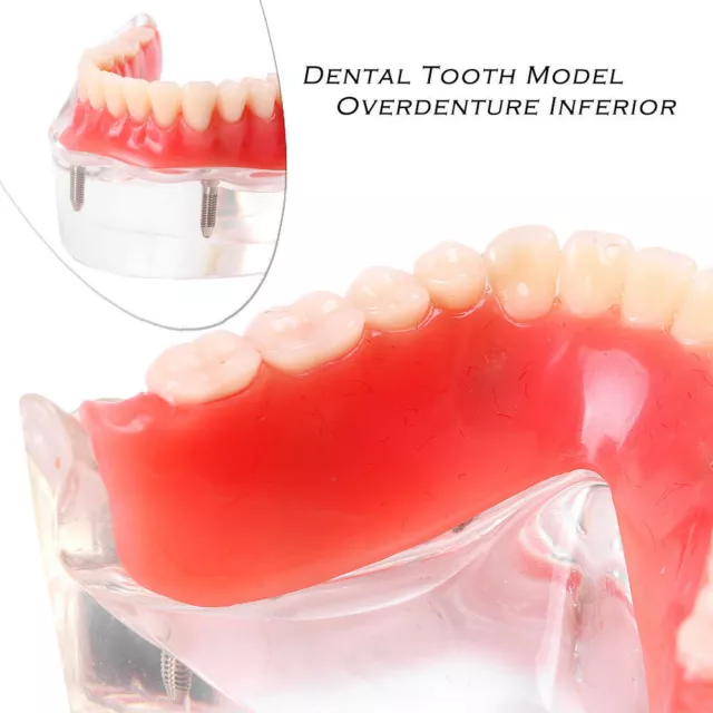 Dental Tooth Model Overdenture Inferior with 4 Implants Demo 6002 Clear Inferior 3