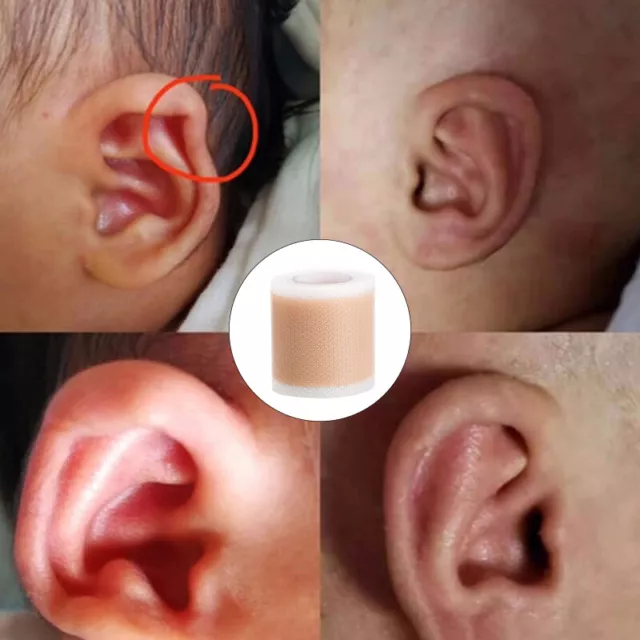 Baby Ear Correctors Medical Silicone Tape Infant Ear Correction Patch JL