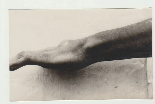Vintage Medical Oddity Disease Accident Diformity Photo Freak Strange Circus 06