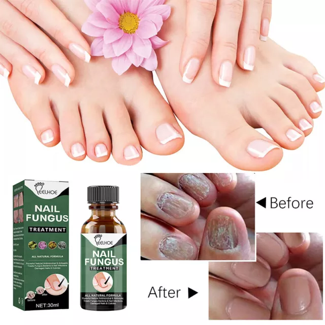 Nail Repair Serum Nail Fungal Treatment Serum Onychomycosis Paronychia Anti-Fung 2