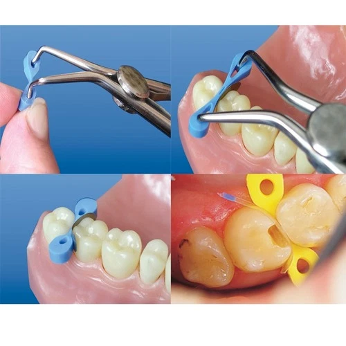 30 Pcs/box Dental Transparent Resin Sectional Contoured Matrices Matrix L+S