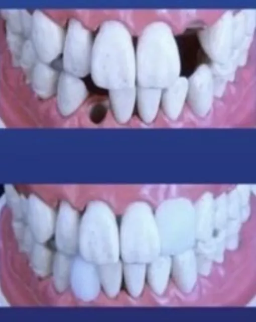 Quick Dental provisorischer Zahnersatz Temporärer Zahn Reparatur  Zahnfüllung✅