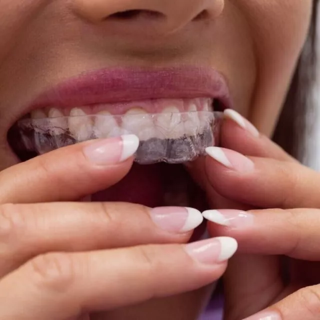 Bite Dentale Notturno Automodellante anti Bruxismo Paradenti OzDenta trasparente