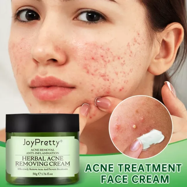 JoyPretty Acne Face Cream Herbal Pimple Scar Removal Shrink Pore Oil Control Moi