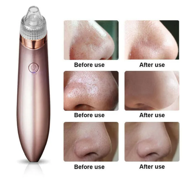 Electric Blackhead Vacuum Pore Cleaner Acne Pimple Remover Strong Suction Tool E