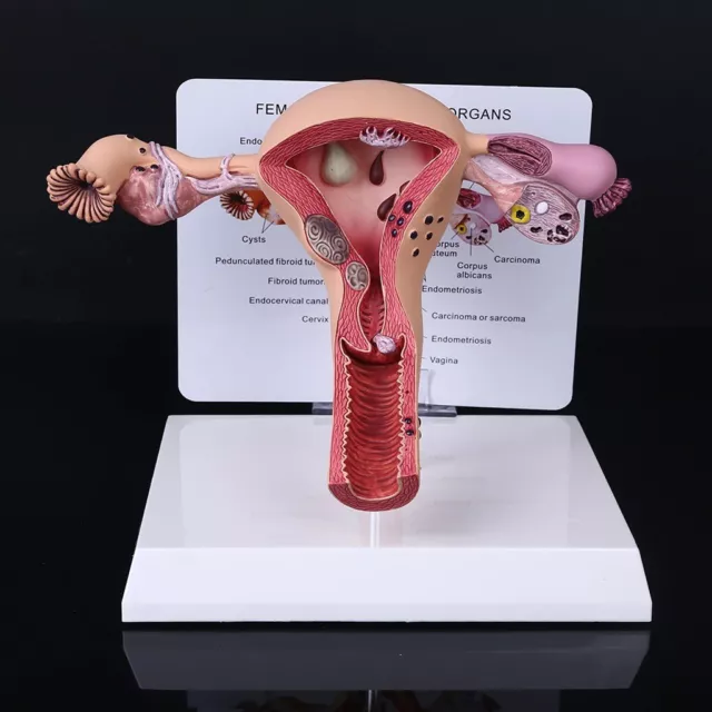 Human Female Medical anatomy Pathological Uterus and ovary anatomical Model