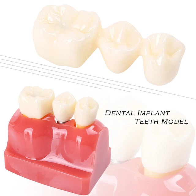 NEW Dental Implant Analysis Crown Bridge Demonstration Study Teeth Model @
