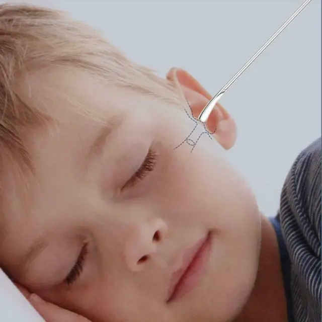 6X Removedor de cera para oídos Limpiador de hisopo Removedor de cerumen inteligente seguro acero X3J0