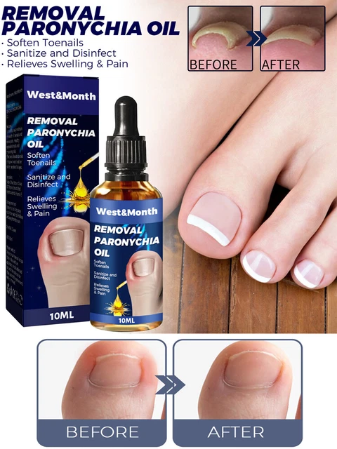Reparación de uñas esencia aceite eliminación onicomicosis suero hongos en las uñas cura liberadores ◑