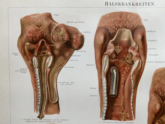 antike Grafik Medizin / Anatomie: Halskrankheiten Chromolithografie um 1900 3