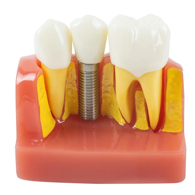 Professional Dental Study Model with Removable Teeth - Implant Crown  Bridge