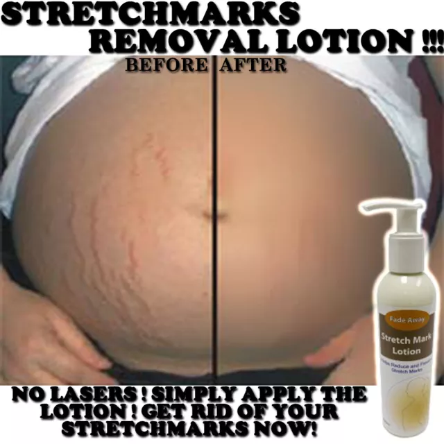 Fade Away Stretch Mark Lotion Creme Max Stärke Entfernt Dehnungsstreifen