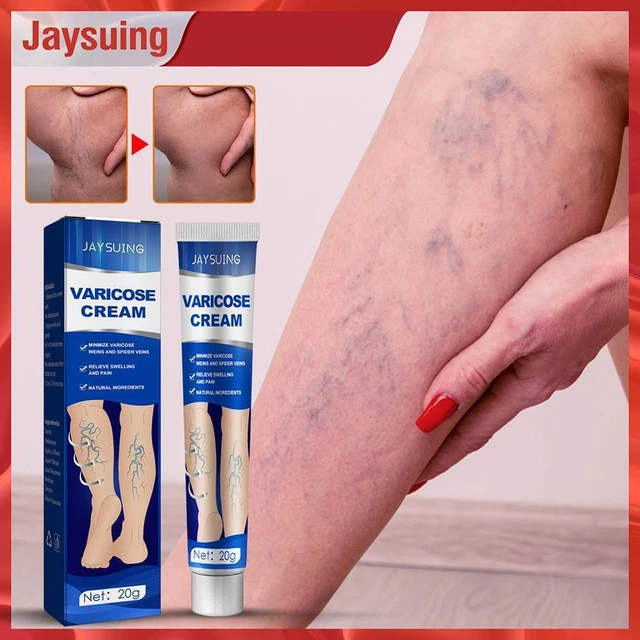 Crema massaggio vasculite flebite ragno sollievo dolore alle gambe per gambe vene ragno