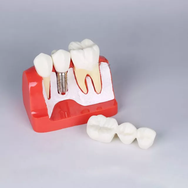 Dental Implant Analysis Crown Bridge Demonstration Study Teeth Model