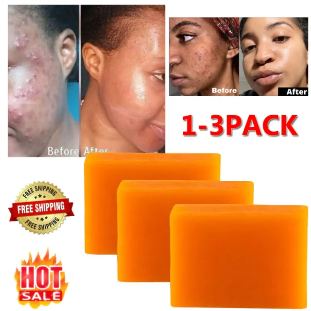 Original Kojic Acid Soap Bars, Skin Whitening Lightening Acne Dark Spots Removal