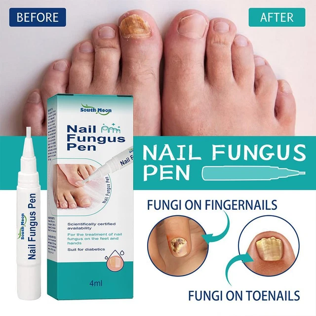 PARONYCHIA TREATMENT PEN Toe Nail Fungus Repair Anti Infection Promote