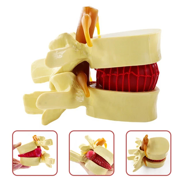 Disc Model Back SPINE MODEL HUMAN Lumbar Herniation Intervertebral Disc Body £20.40 ...