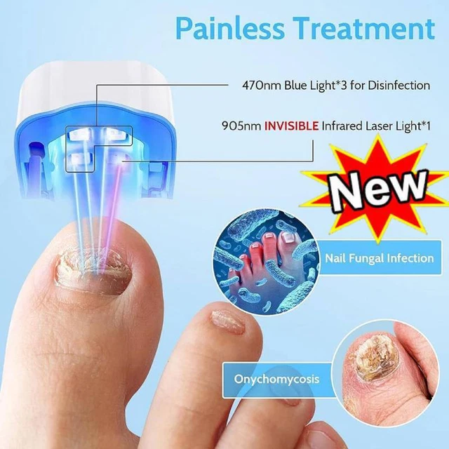 NAIL FUNGUS LASERDEVICE, Anti Fungal Treatment Laser Device for
