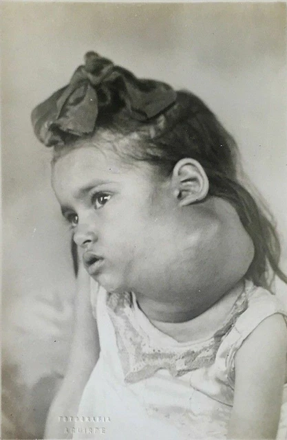 Antique Medical Goiter Photo 408b Oddleys Strange & Bizarre