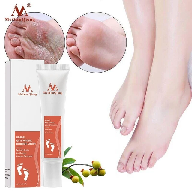Crema ungüento aliviar la picazón reparación uñas de los pies control de hongos útil