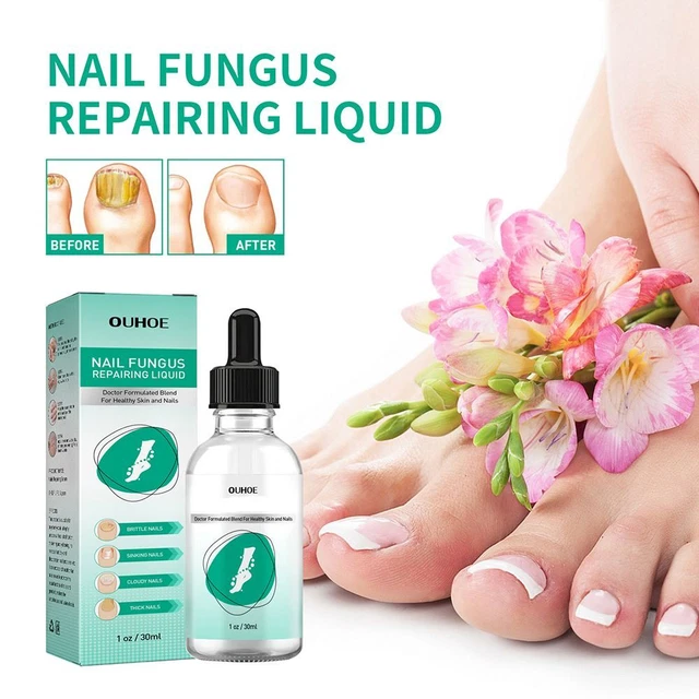 riparazione funghi liquido dita dei piedi unghie fungo riparazione gel inumidire unghie
