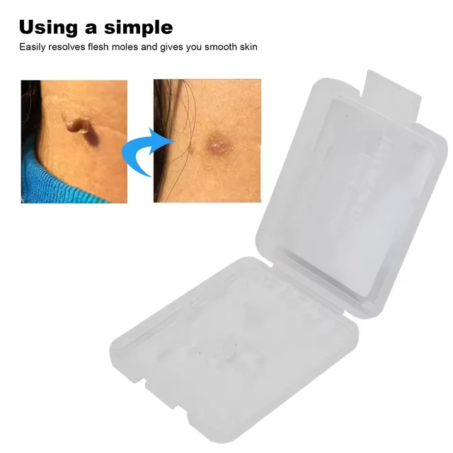 Compound Skin Tag SKIN TAG REMOVAL Rubber Bands Safe Band Non Toxic Mole Wart Skin Care ...