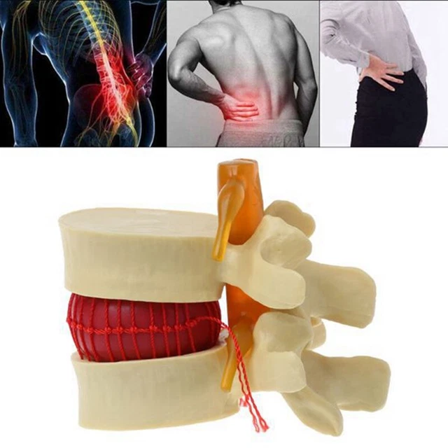 Modello Anatomico Colonna Lombare Con Ernia Del Disco (1,5x) - PVC Medicale - Per Insegnamento E Comunicazione Medico-Paziente