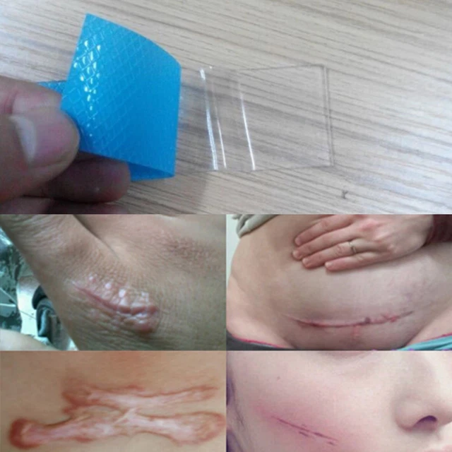 Parche cicatriz de gel de silicona de 3,5*12 cm 1 pieza diluir la cicatriz HGZ8