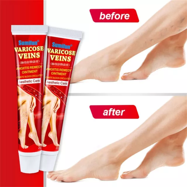 Treatment Vein Care Fading Cream Herbal Ointment Legs Varicose Veins Cream