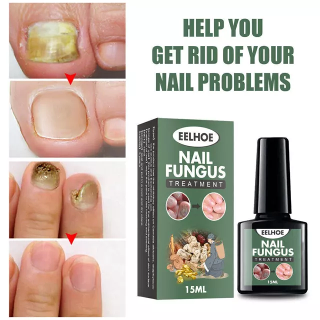 Nail Fungus Treatment Repair Essence to Removal Foot Toe Fungal Anti-infection