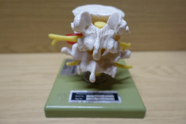 ADAM ROUILLY MEDICAL Model Hernia Of Dorsolateral Intervertebral Disc ...