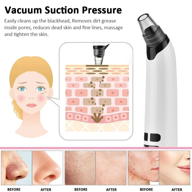 Punti neri rimozione acne detergente punti neri pulizia pelle viso macchina