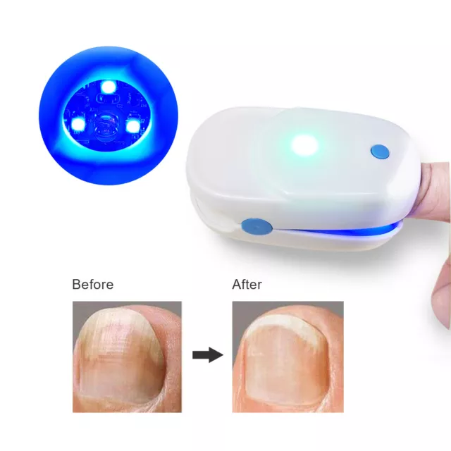 Nail Fungus Laser Device Light Therapy Onychomycosis Toes Treatment 905nm Home
