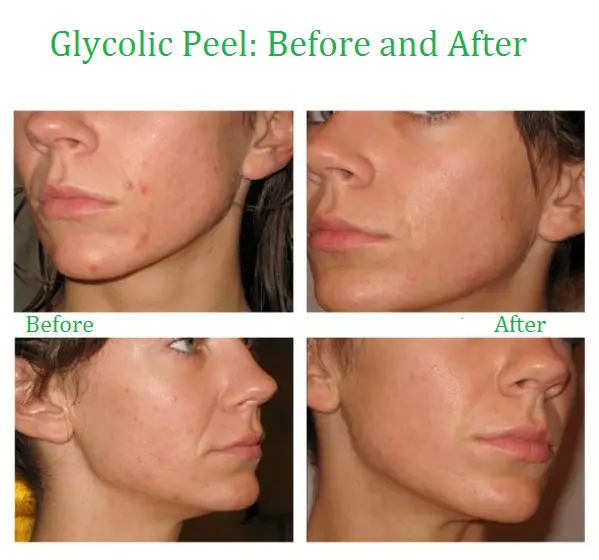 Glycolic Acid Face Peel Kit Medical Grade Pure Acne Scars Wrinkles Anti-Aging 2