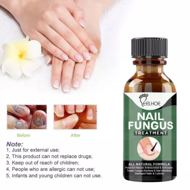 30ml Nail Fungus Treatment Best Nail Repair Effective NEW